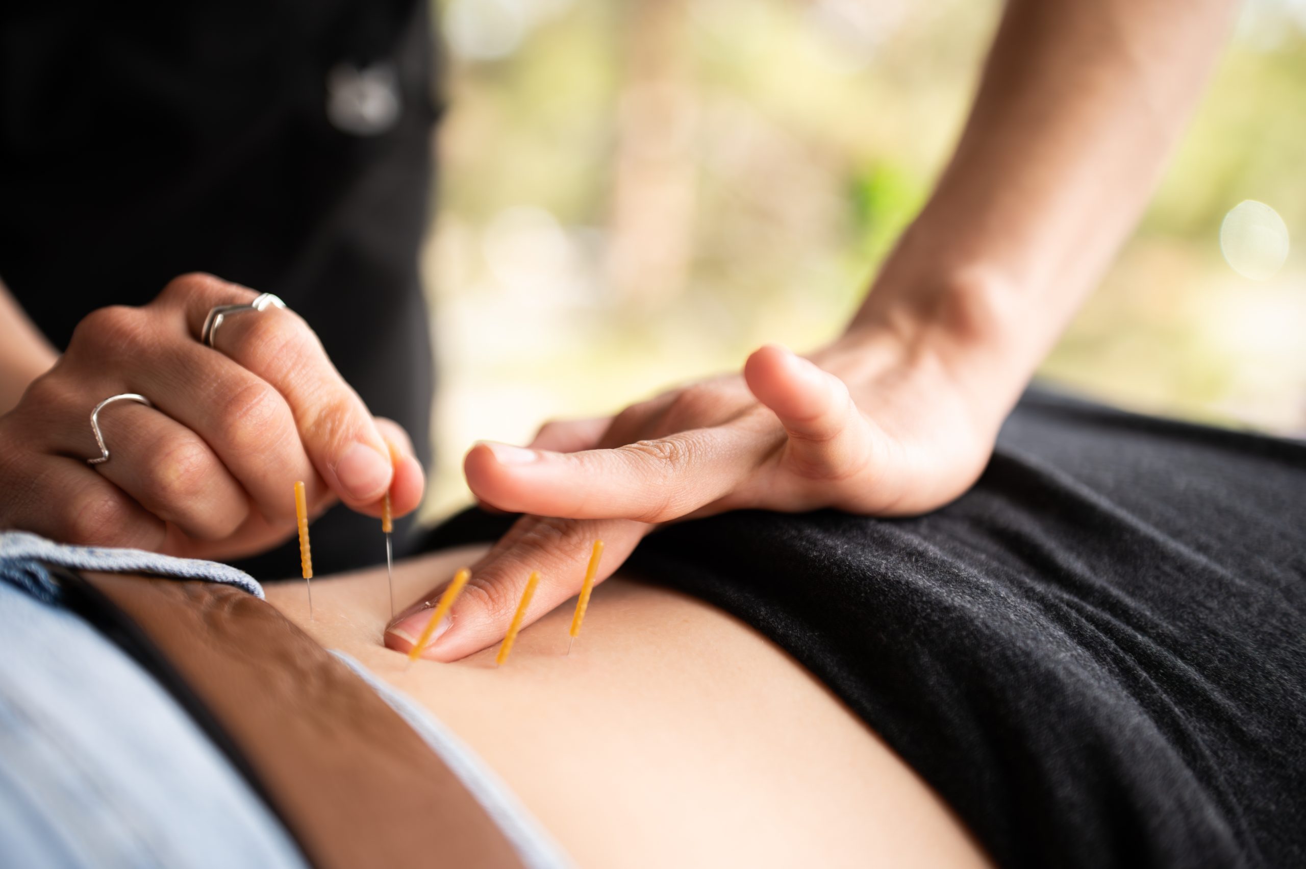 Dry,needle,therapy:,close Up,hands,,back,wellness.